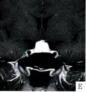 【病例】Rathke囊肿1例MR影像表现