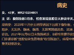 卵巢囊腺瘤1例MR影像