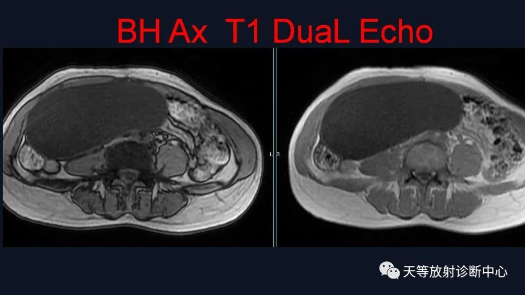 【病例】卵巢囊腺瘤1例MR影像-3