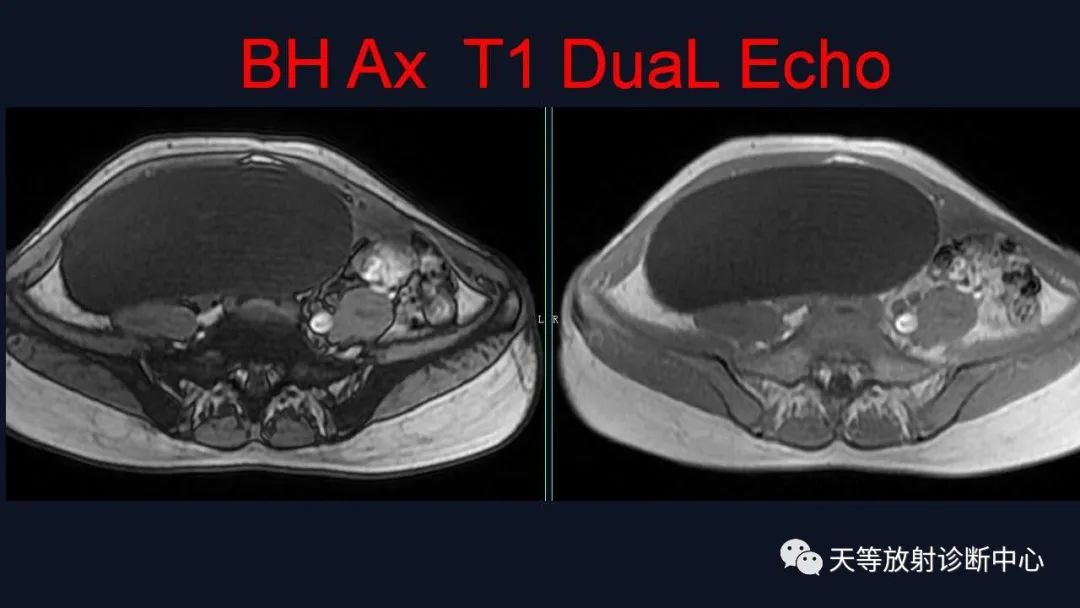 【病例】卵巢囊腺瘤1例MR影像-4