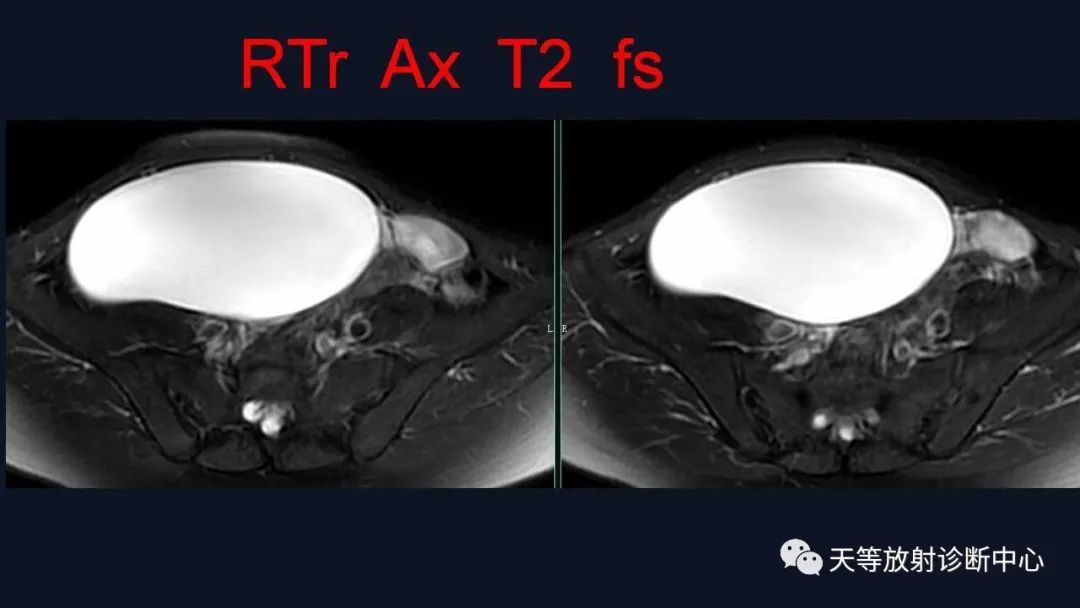 【病例】卵巢囊腺瘤1例MR影像-6