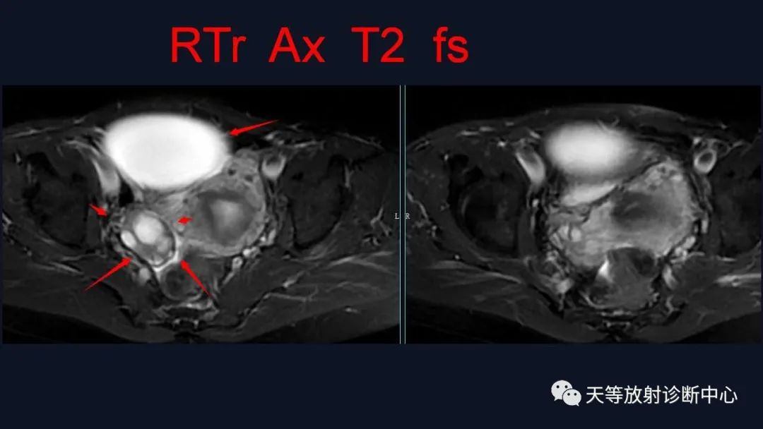 【病例】卵巢囊腺瘤1例MR影像-8
