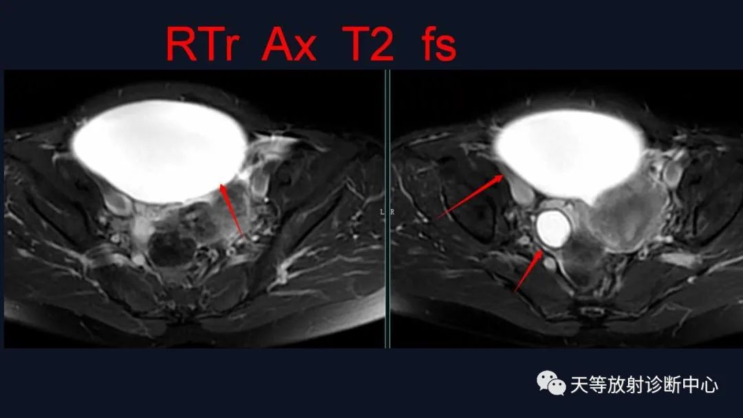 【病例】卵巢囊腺瘤1例MR影像-7