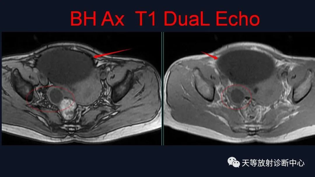 【病例】卵巢囊腺瘤1例MR影像-9