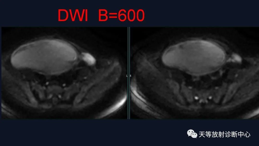 【病例】卵巢囊腺瘤1例MR影像-10