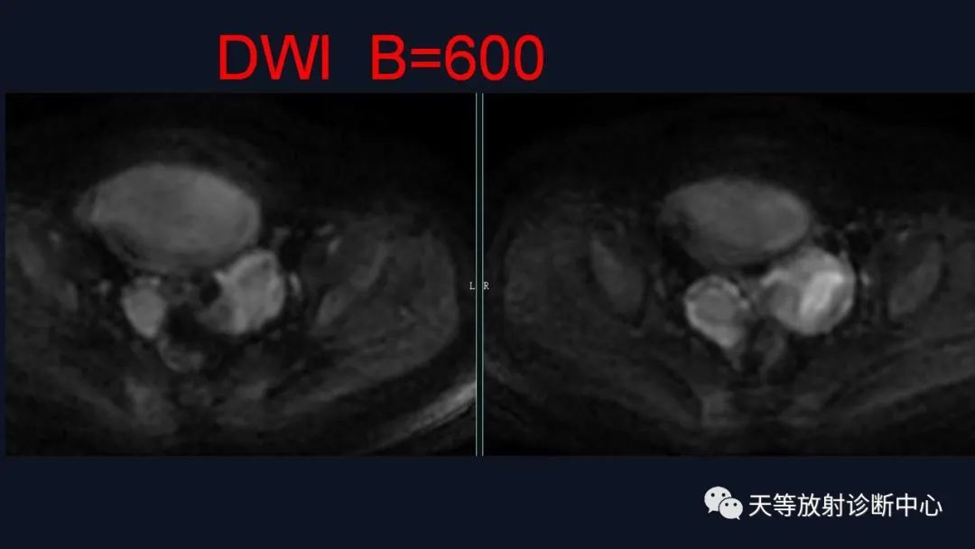 【病例】卵巢囊腺瘤1例MR影像-11
