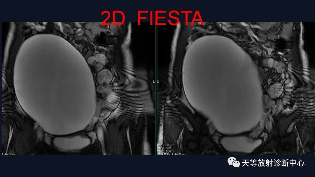 【病例】卵巢囊腺瘤1例MR影像-12