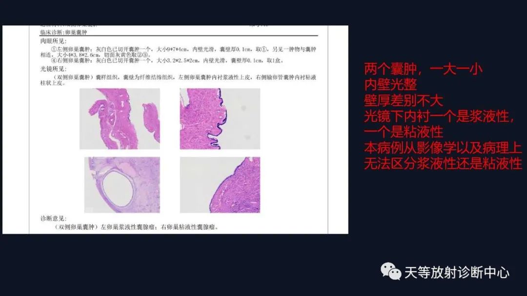 【病例】卵巢囊腺瘤1例MR影像-18