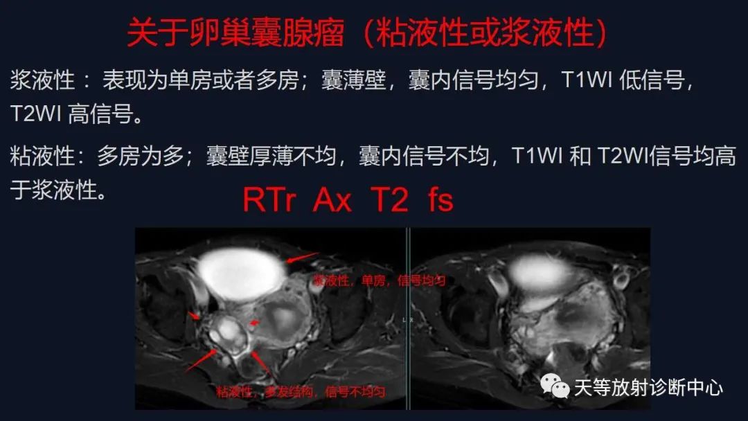 【病例】卵巢囊腺瘤1例MR影像-25