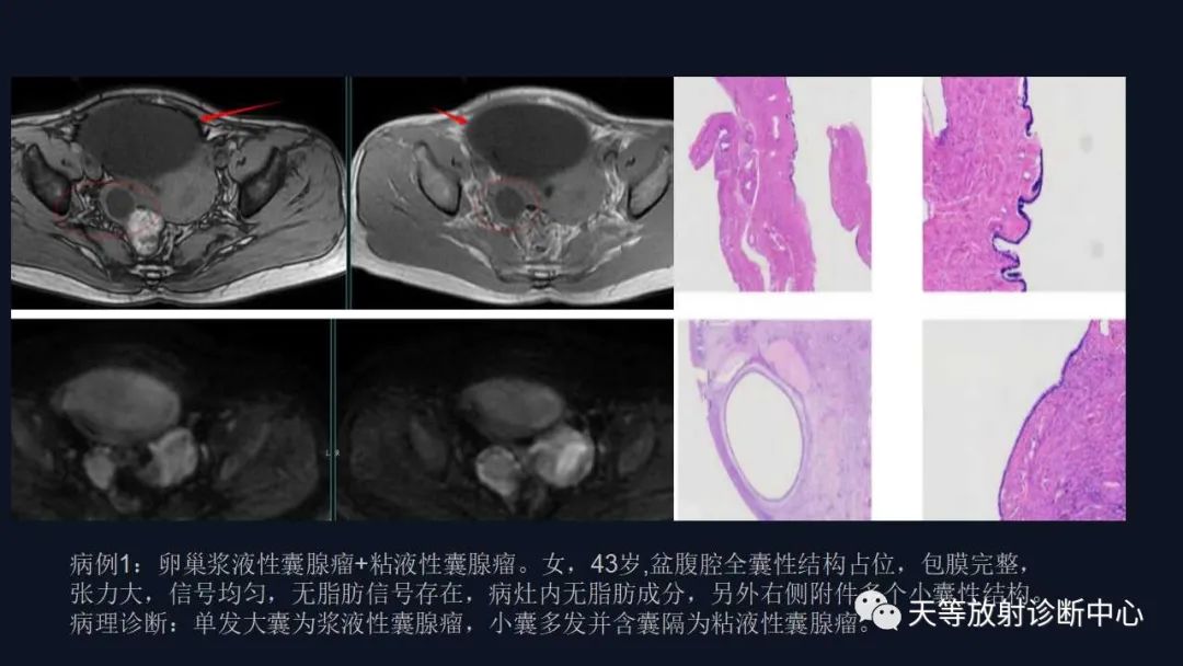 【病例】卵巢囊腺瘤1例MR影像-26