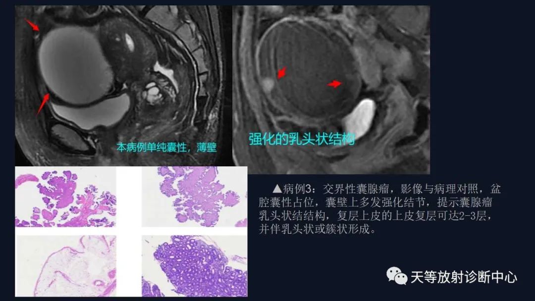 【病例】卵巢囊腺瘤1例MR影像-29