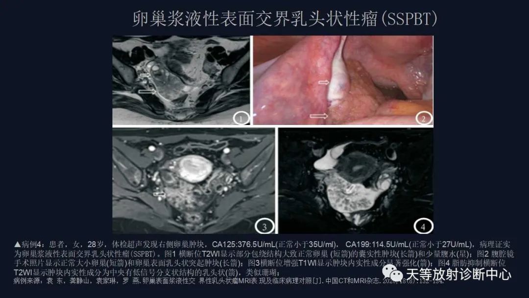 【病例】卵巢囊腺瘤1例MR影像-30