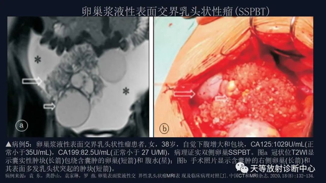 【病例】卵巢囊腺瘤1例MR影像-31