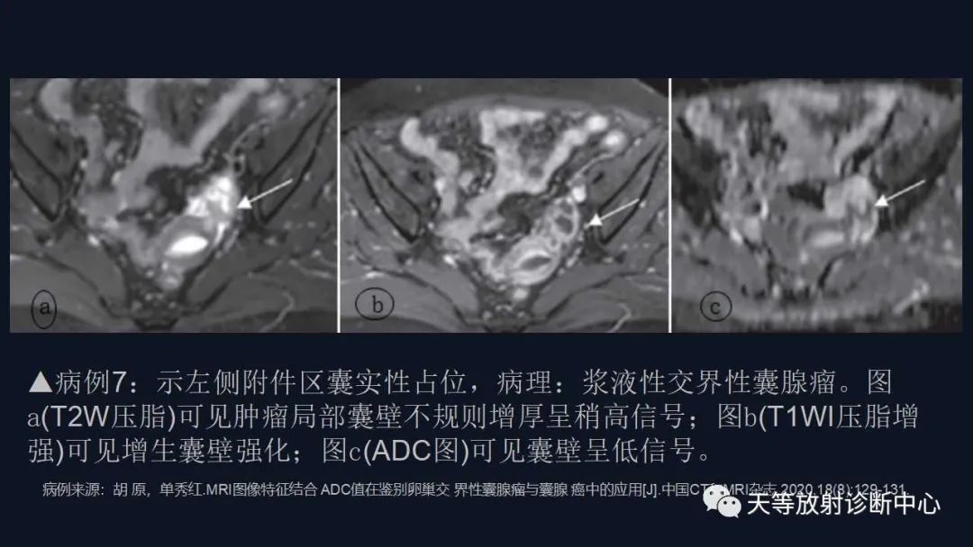 【病例】卵巢囊腺瘤1例MR影像-34