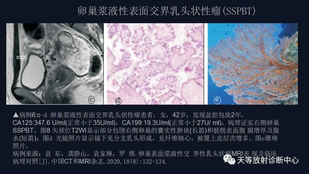 【病例】卵巢囊腺瘤1例MR影像-32
