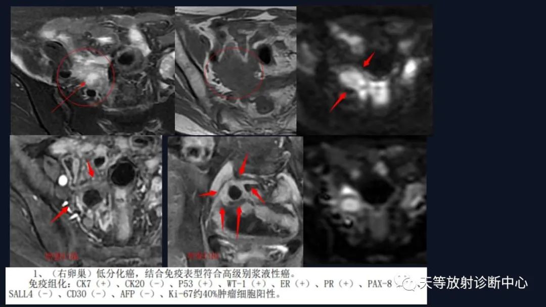 【病例】卵巢囊腺瘤1例MR影像-37