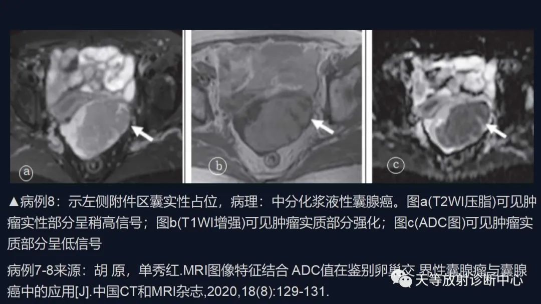 【病例】卵巢囊腺瘤1例MR影像-36