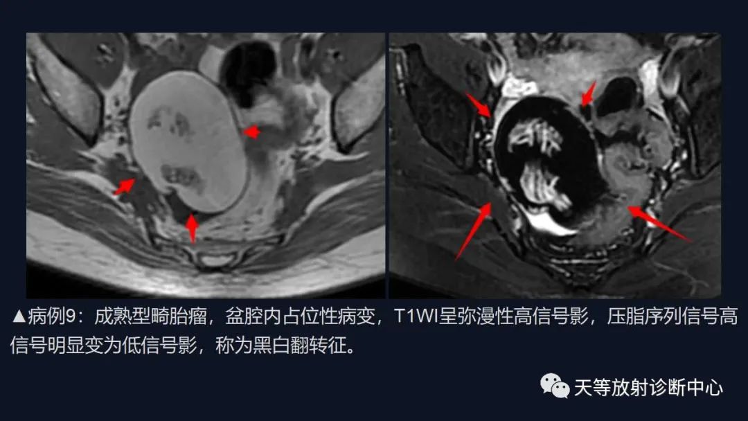 【病例】卵巢囊腺瘤1例MR影像-41