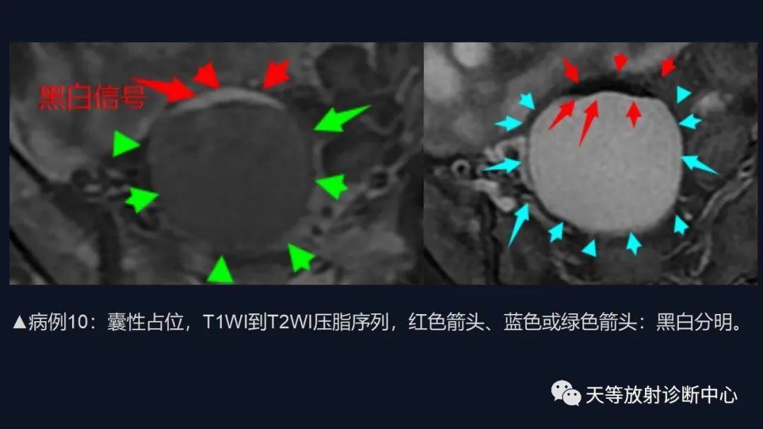 【病例】卵巢囊腺瘤1例MR影像-42