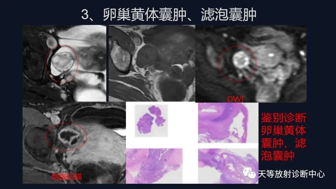 【病例】卵巢囊腺瘤1例MR影像-43