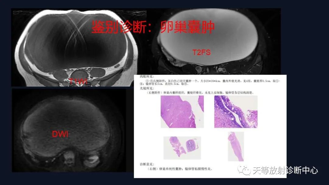 【病例】卵巢囊腺瘤1例MR影像-44