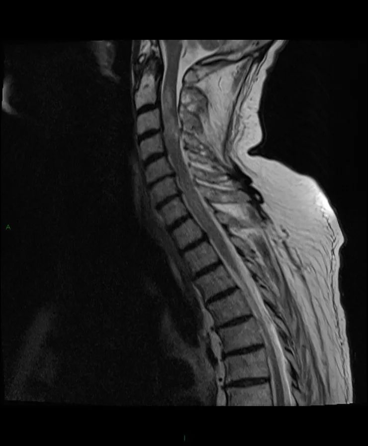 【病例】脊髓星形细胞瘤1例MR影像-2