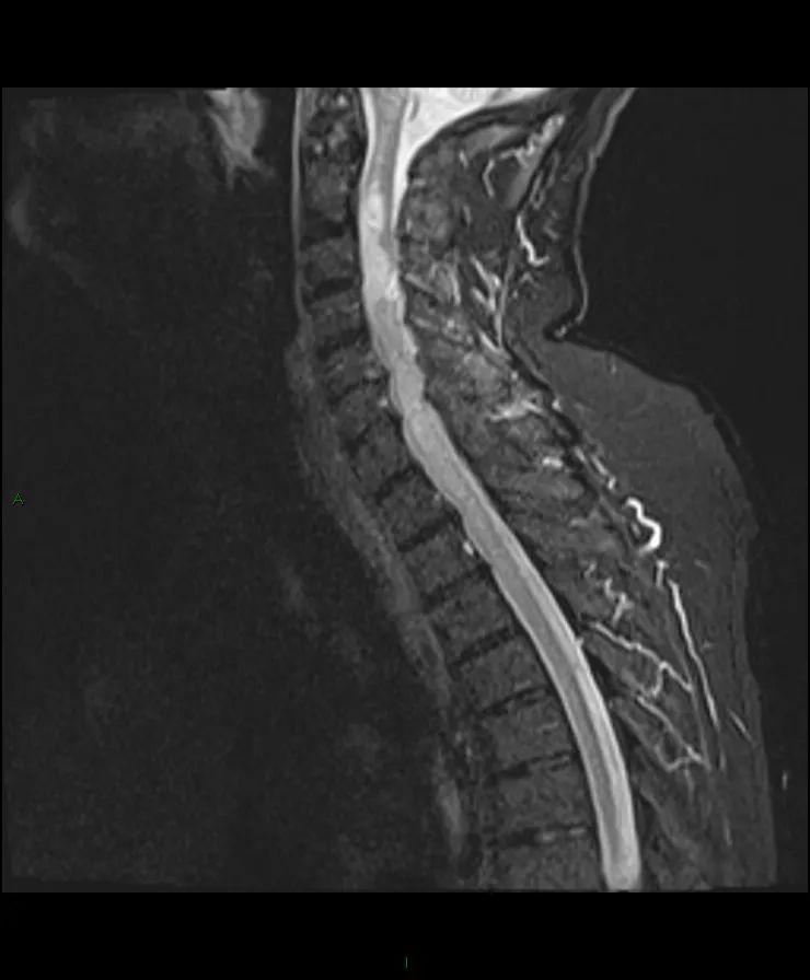 【病例】脊髓星形细胞瘤1例MR影像-3