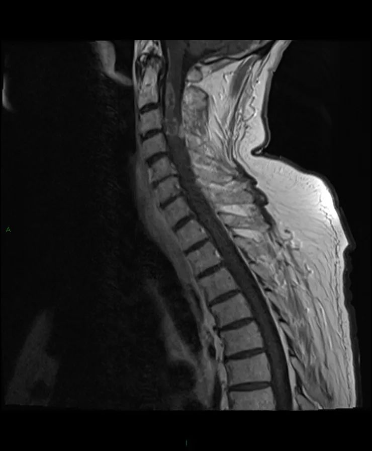 【病例】脊髓星形细胞瘤1例MR影像-4