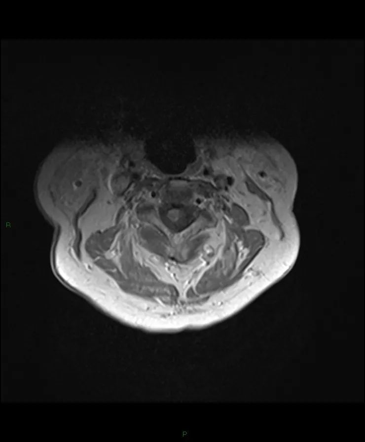 【病例】脊髓星形细胞瘤1例MR影像-5