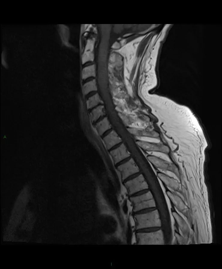 【病例】脊髓星形细胞瘤1例MR影像-1
