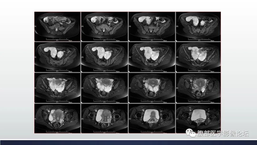 【病例】子宫内膜透明细胞癌1例MR-7