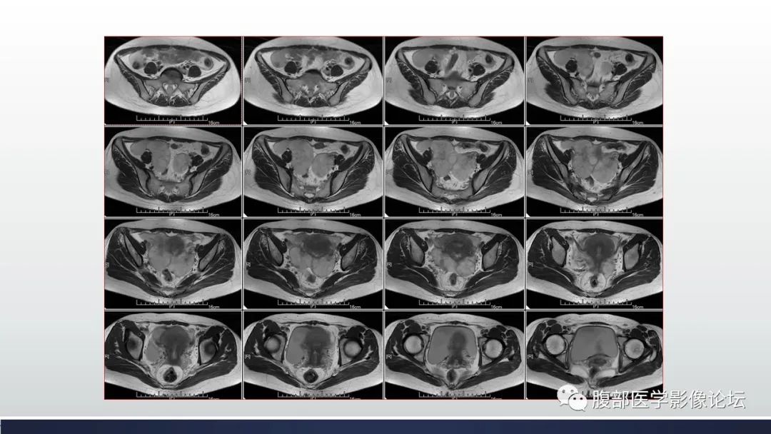 【病例】子宫内膜透明细胞癌1例MR-6