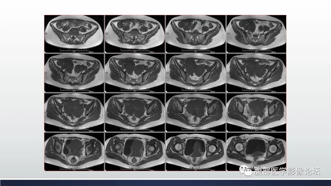 【病例】子宫内膜透明细胞癌1例MR-8