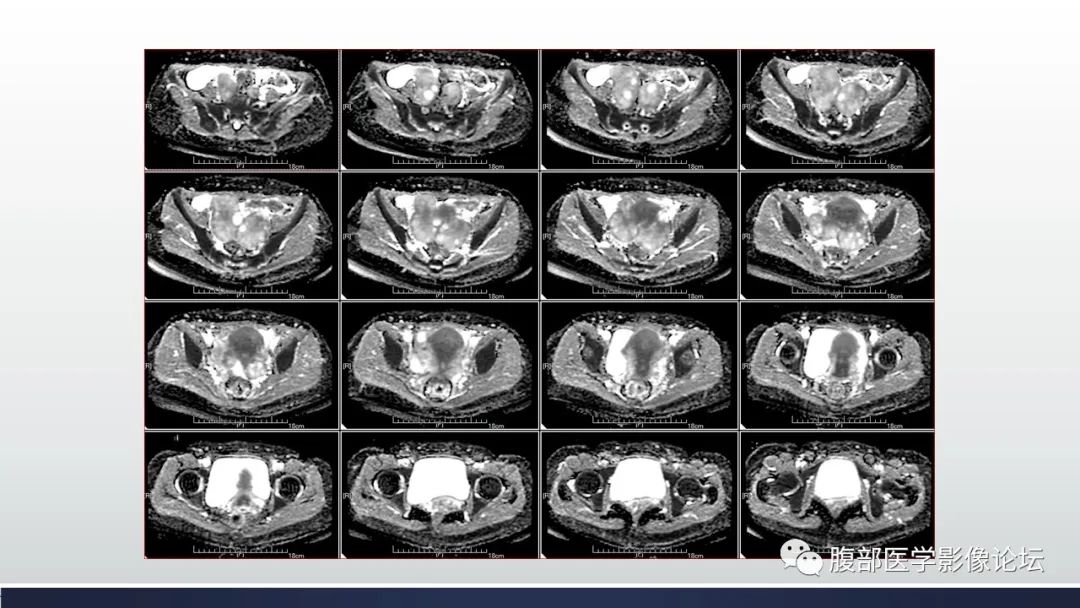 【病例】子宫内膜透明细胞癌1例MR-10