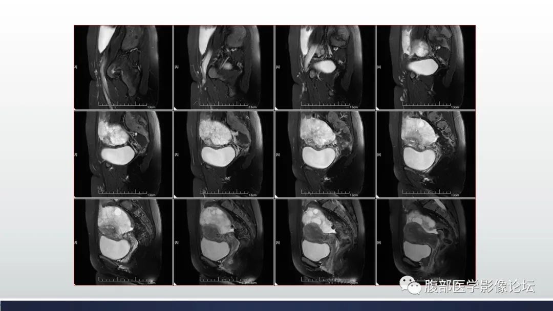 【病例】子宫内膜透明细胞癌1例MR-11
