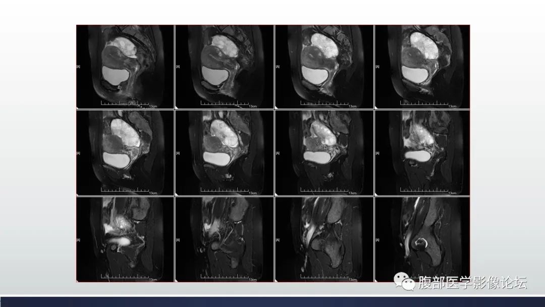 【病例】子宫内膜透明细胞癌1例MR-12