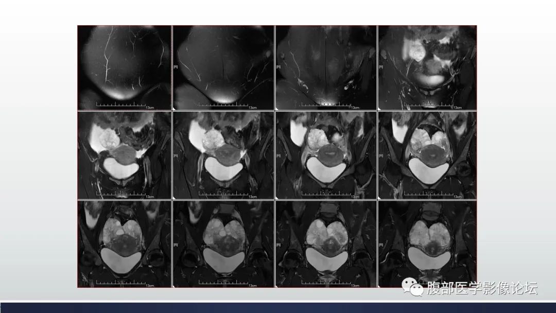 【病例】子宫内膜透明细胞癌1例MR-13