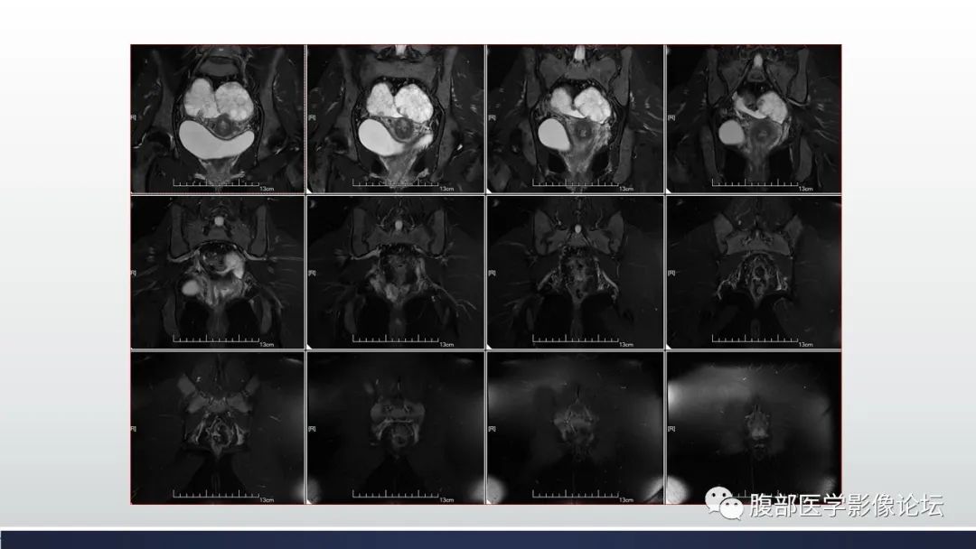 【病例】子宫内膜透明细胞癌1例MR-14