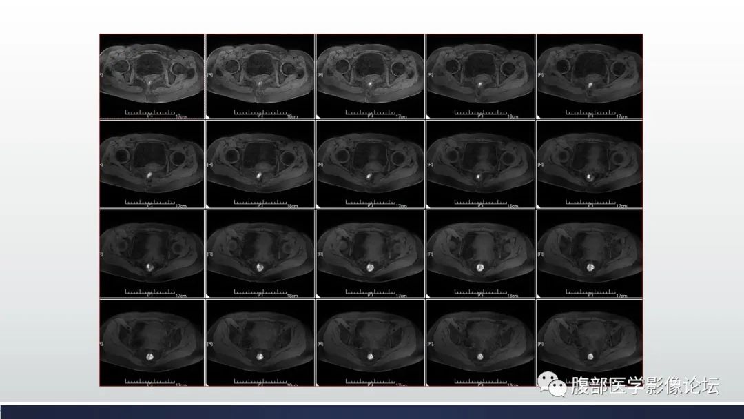 【病例】子宫内膜透明细胞癌1例MR-15