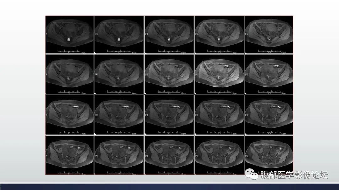 【病例】子宫内膜透明细胞癌1例MR-16