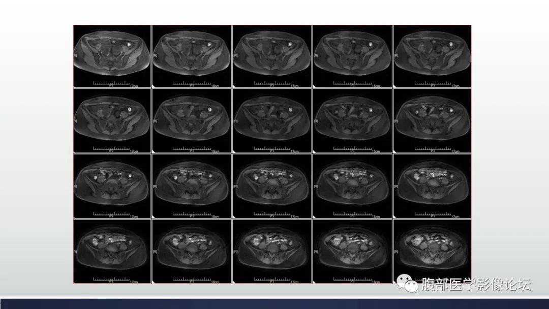 【病例】子宫内膜透明细胞癌1例MR-17