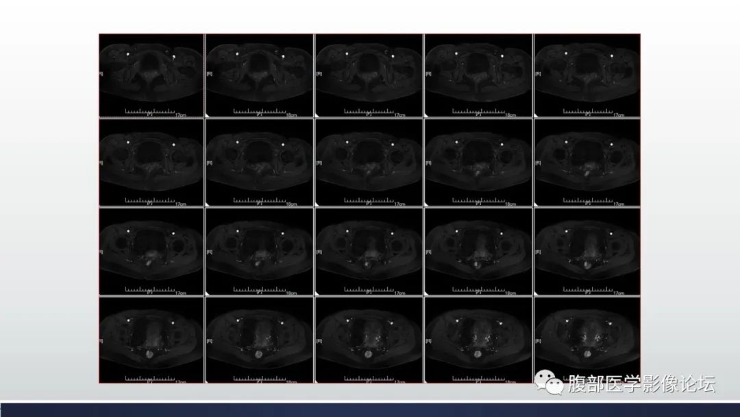 【病例】子宫内膜透明细胞癌1例MR-18