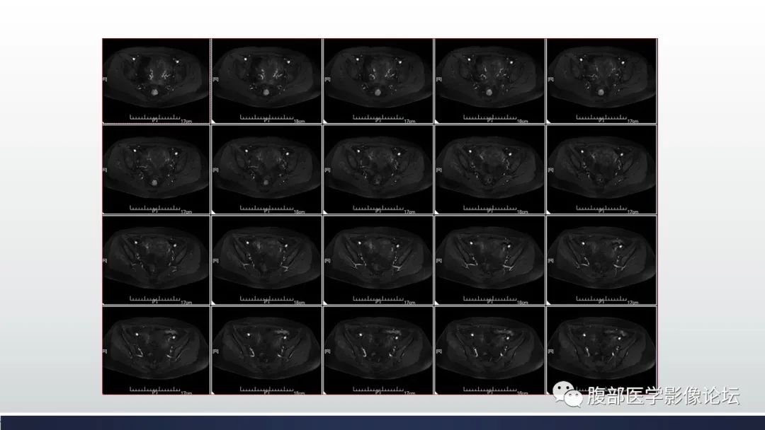 【病例】子宫内膜透明细胞癌1例MR-19