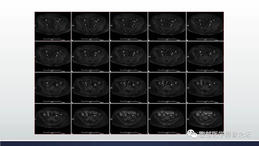 【病例】子宫内膜透明细胞癌1例MR-20