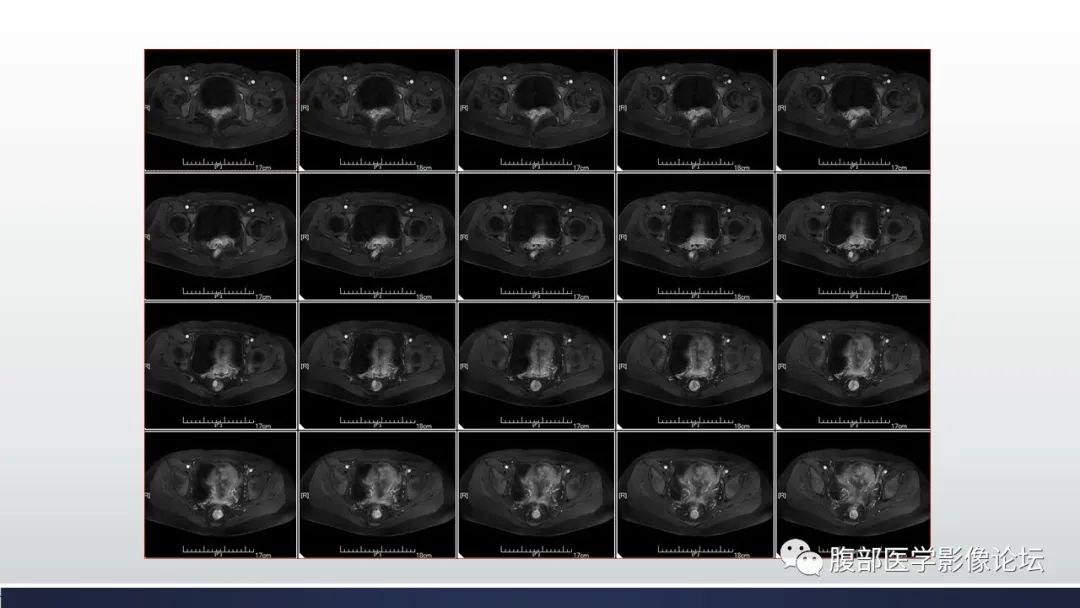 【病例】子宫内膜透明细胞癌1例MR-21