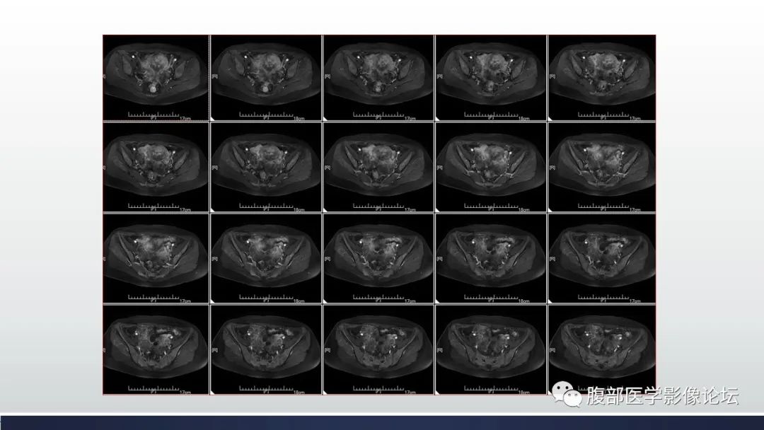 【病例】子宫内膜透明细胞癌1例MR-22