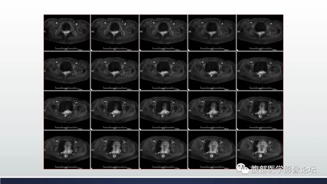 【病例】子宫内膜透明细胞癌1例MR-24