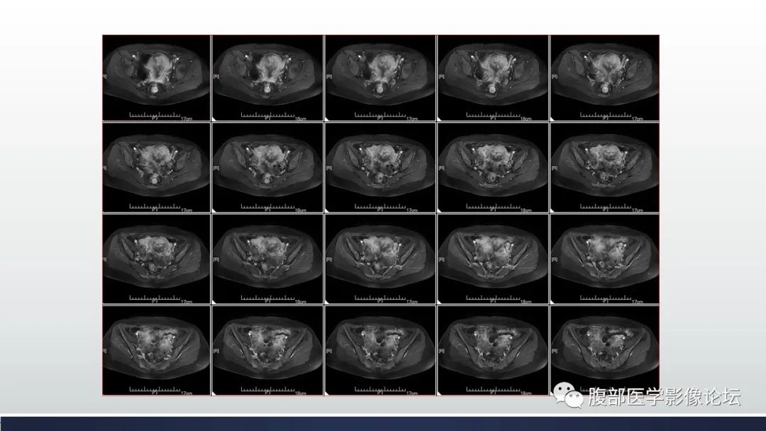 【病例】子宫内膜透明细胞癌1例MR-25
