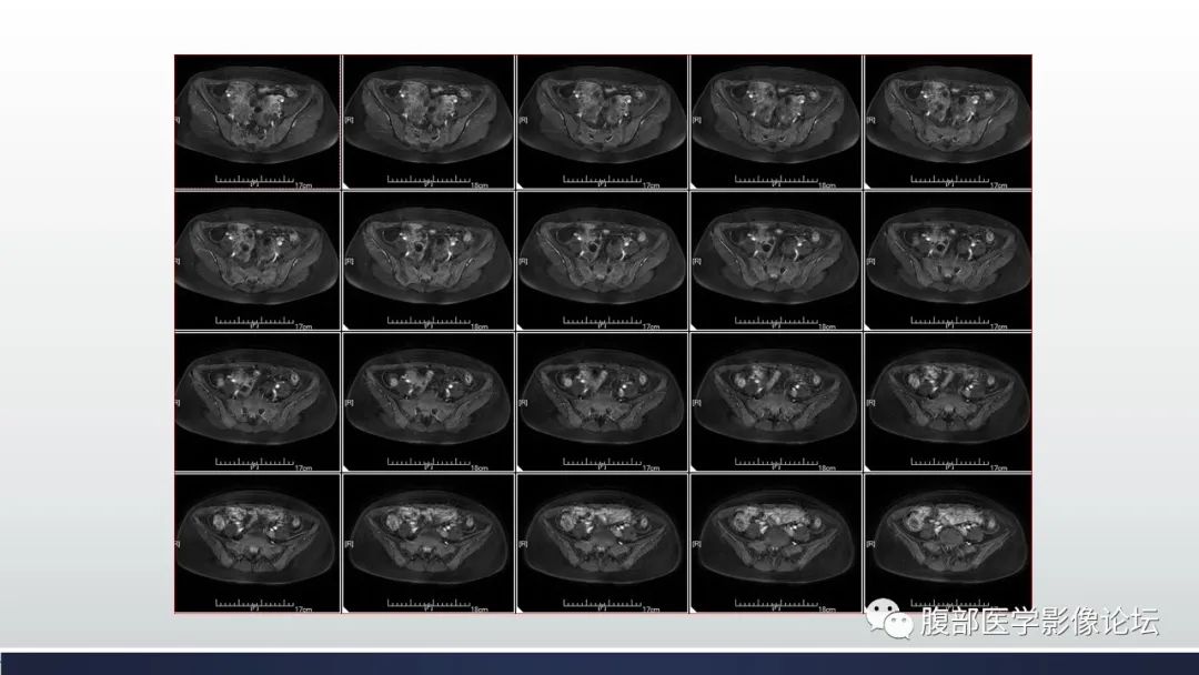 【病例】子宫内膜透明细胞癌1例MR-26