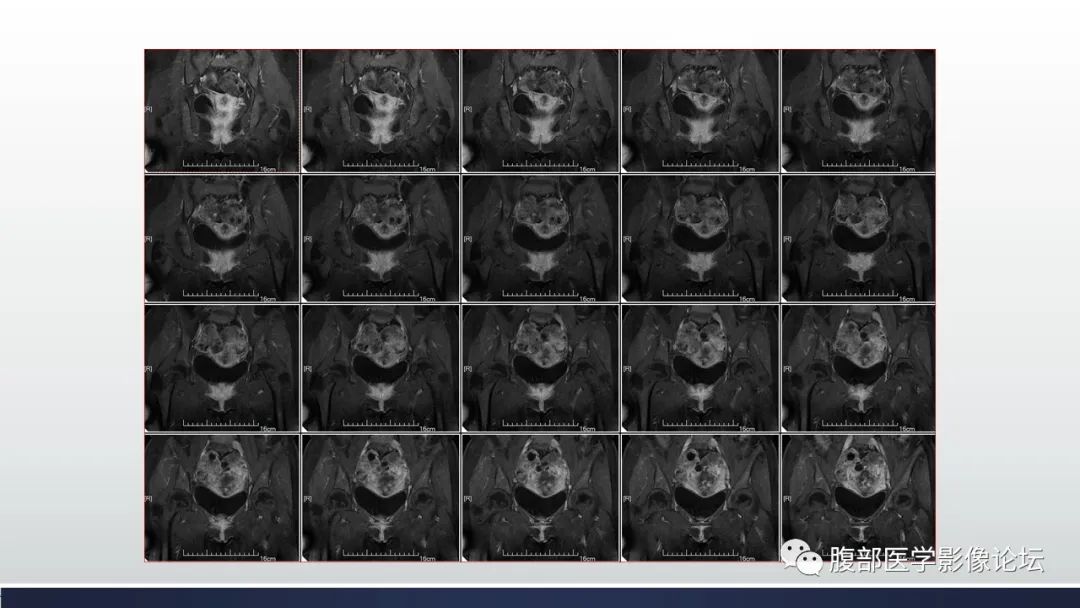 【病例】子宫内膜透明细胞癌1例MR-27